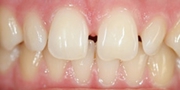 Cosmetic Dentistry Before After Appleton Fox Valley Green Bay Neenah